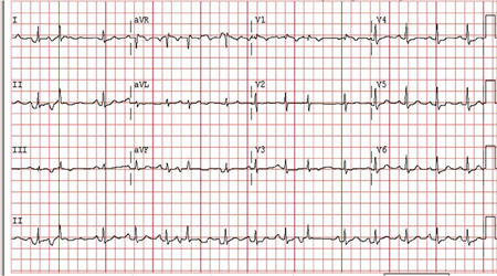 Chronic Atrial Fibrillation - Images 