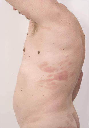 Cutaneous T Cell Lymphoma Images BMJ Best Practice