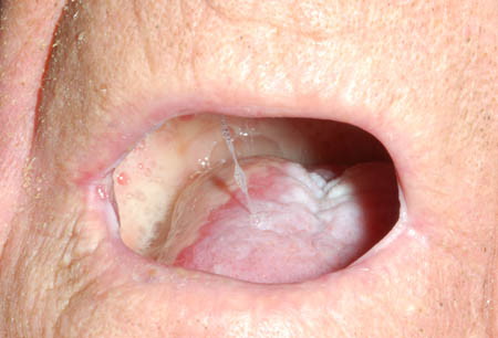 mucositis oral bmj practice 1135 bestpractice differentials