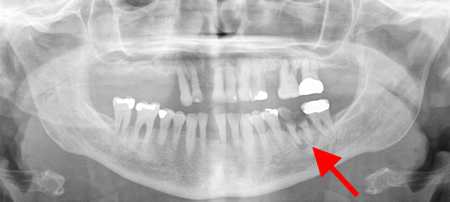 Dental abscess - Investigations | BMJ Best Practice