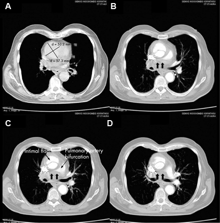 Pruebas para diagnosticar y determinar la etapa del cáncer de próstata