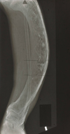 Paget S Disease Of Bone Images Bmj Best Practice 10752 Hot Sex Picture