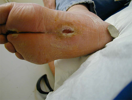 Diabetic neuropathy - Approach | BMJ Best Practice