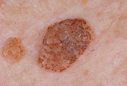 Seborrheic Keratosis Symptoms Diagnosis And Treatment Bmj Best