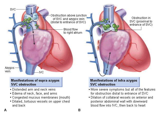 Superior Vena Cava Syndrome Signs Symptoms