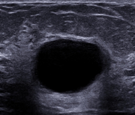 Fibrocystic breasts images