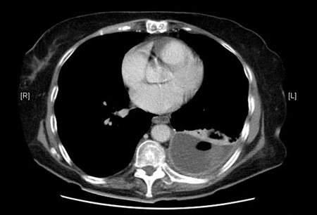 Empyema images