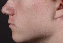 Acne vulgaris images