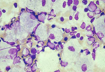 Common hereditary lysosomal storage diseases images