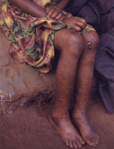 Kwashiorkor images