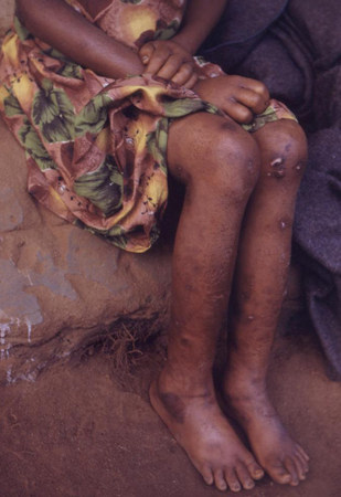 Kwashiorkor images