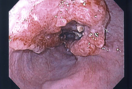 Oesophageal cancer images