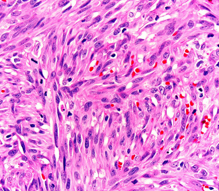 Kaposi sarcoma - Investigations | BMJ Best Practice US