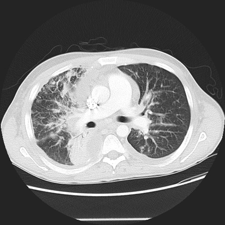 Kaposi sarcoma - Investigations | BMJ Best Practice US