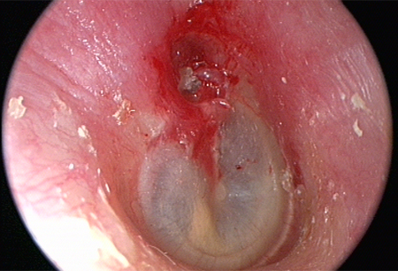 Colesteatoma images