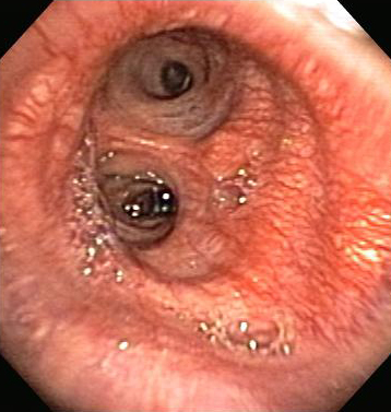 Assessment of haemoptysis images