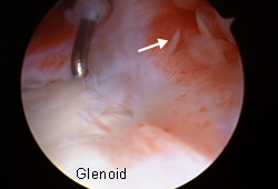 Adhesive capsulitis images