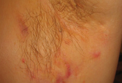 Hidradenitis suppurativa images