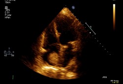 Mixoma atrial images