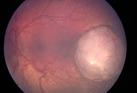 Retinoblastoma images