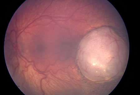 视网膜母细胞瘤 images