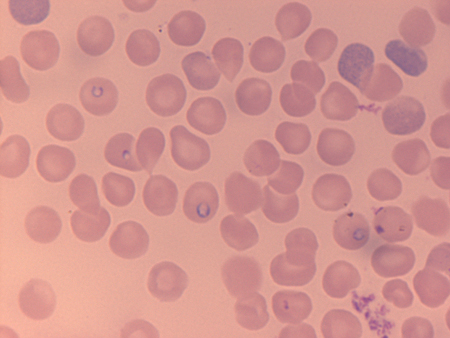 Babesiosis images