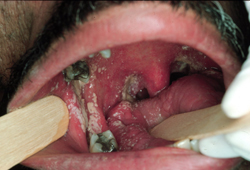 Oral candidiasis images