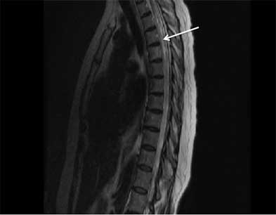 Transverse myelitis images