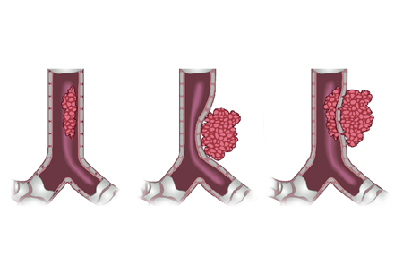 Central airway obstruction - Symptoms, diagnosis and treatment | BMJ ...