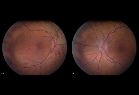 Hipertensão intracraniana idiopática images