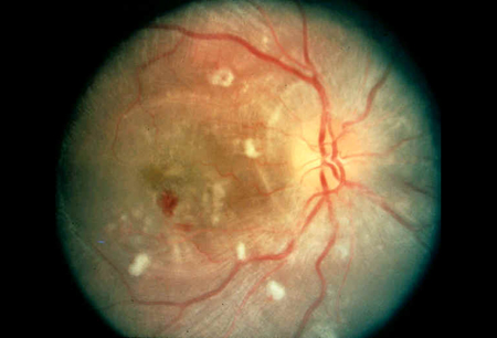 Evaluation of hypertension images