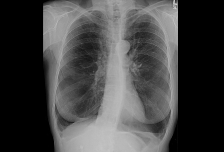 Alpha-1 antitrypsin deficiency images