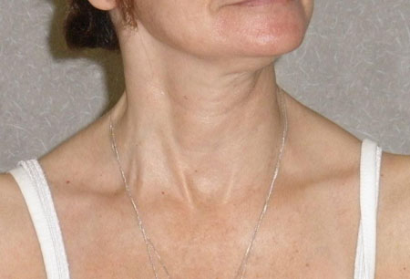 Acquired torticollis images