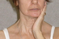 Acquired torticollis