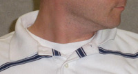 Acquired torticollis