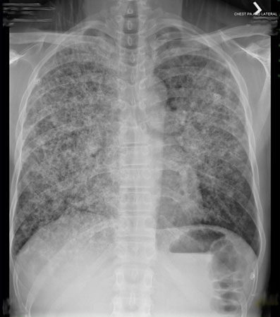 Avaliação do infiltrado pulmonar persistente images