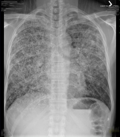 持续性肺部浸润影的评估 images