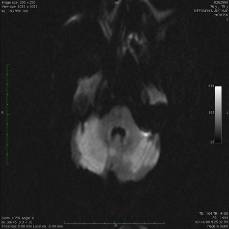 Evaluation of ataxia images