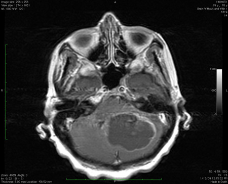 Evaluation of ataxia - Diagnosis Approach | BMJ Best Practice US