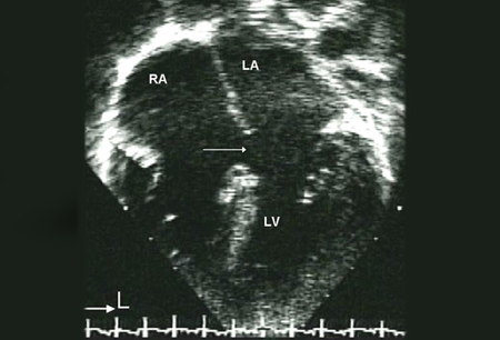 Interatrial communications (atrial septal defects) images