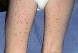 IgA vasculitis (Henoch-Schonlein purpura) images