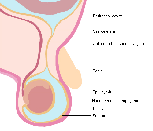 hydrocele-images-bmj-best-practice-us