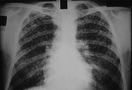 尘肺 images