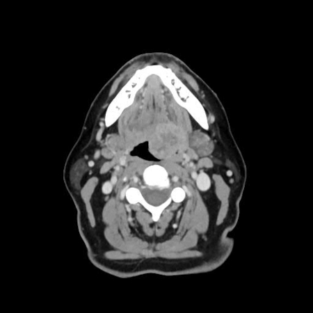 Oropharyngeal cancer images