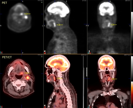 Oropharyngeal cancer images