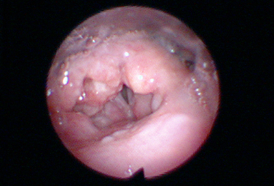 喉癌 images