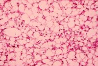 Alcoholic liver disease