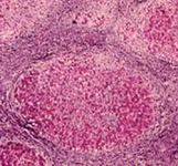 Alcoholic liver disease