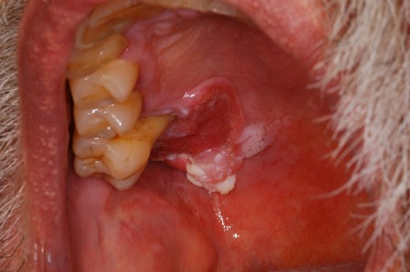 Resumo de herpangina: fisiopatologia, diagnóstico e tratamento