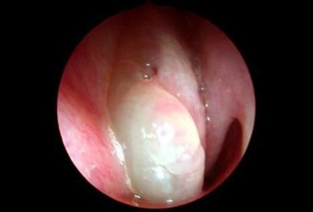 Bilateral nasal polyps sales